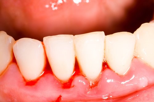 image of bleeding gums
