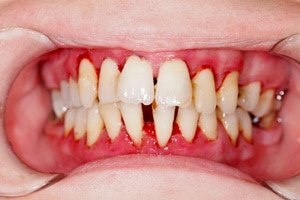 image of loose and migrating teeth