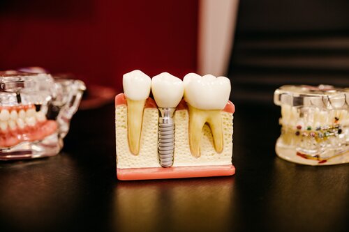 demonstrating the realness of a dental implant